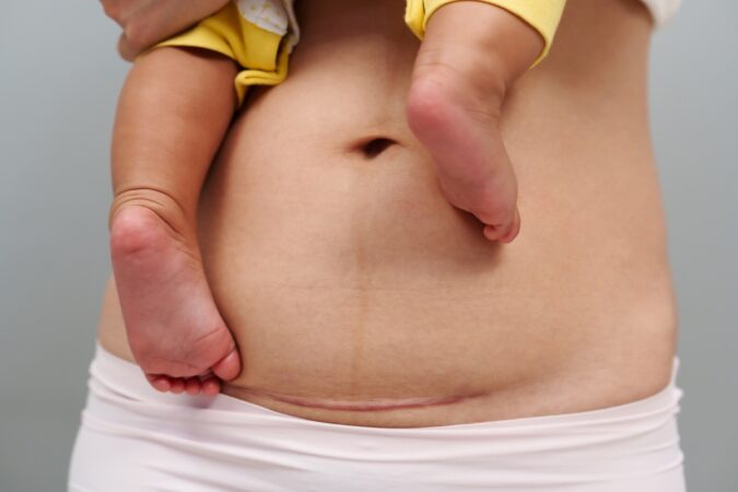 Recovering After a C-Section: What’s Normal and When to Call Your Doctor Recovering After a C-Section: What’s Normal and When to Call Your Doctor