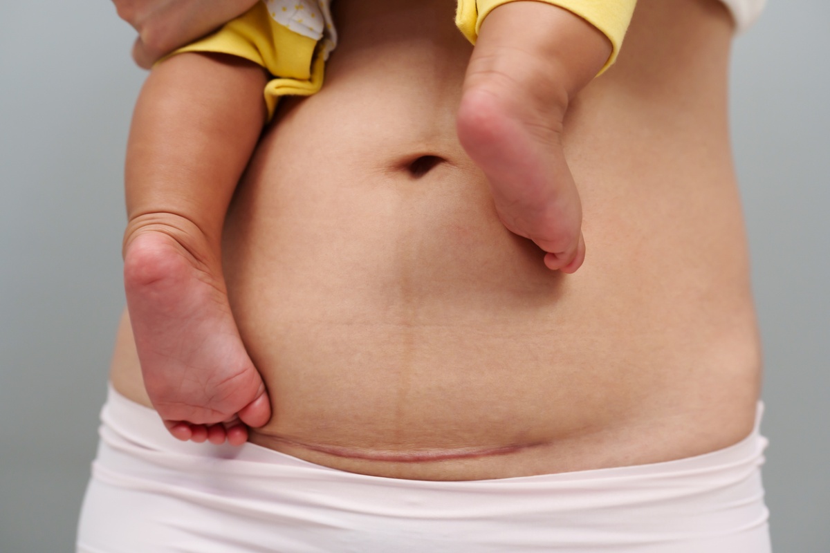 Recovering After a C-Section: What’s Normal and When to Call Your Doctor