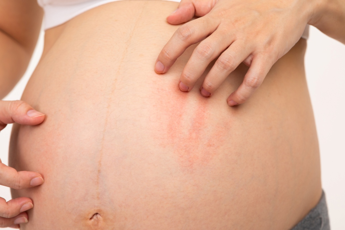 Itching During Pregnancy: What Is Cholestasis?